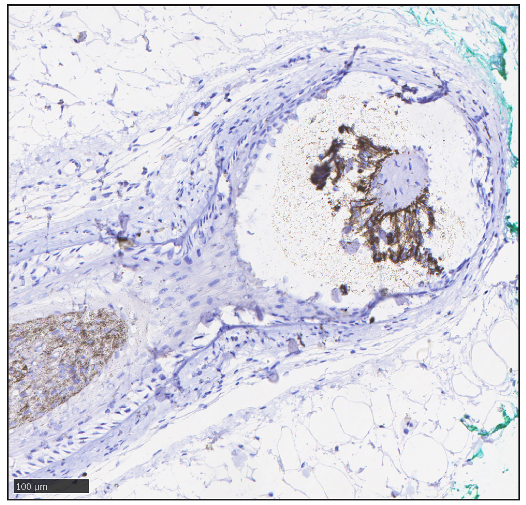 Immunohistochemical staining shows negative type I 5α-reductase (SRD5A1) at the lesions (anti-SRD5A1, ab110123, abcam).