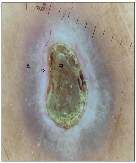 Dermoscopy revealed four zones: a central keratotic plug with a structureless white area (black star), a structureless pink area with dotted vessels (black arrow), and a structureless brown area in concentric rings (black triangle); (Dermlite DL5, 10 X, polarised mode).