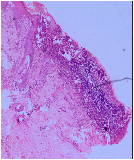 Cornified plug with basophilic debris in an epidermal invagination. (Haematoxylin and eosin, 40x).