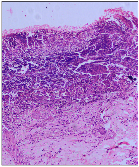 Basophilic debris with no collagen or elastic fibres (Haematoxylin and eosin, 100x).