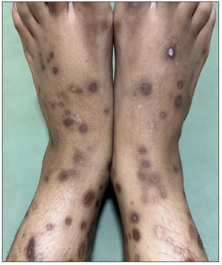 Significant clinical improvement of skin lesions after four months therapy with apremilast.