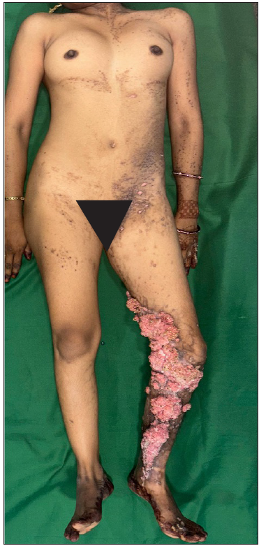 Unilateral involvement of the left side in the form of multiple hyperpigmented and hyperkeratotic plaques in a blaschkolinear pattern.