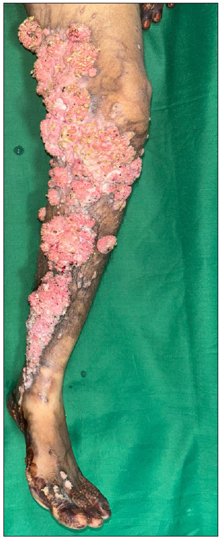 Erythematous, exophytic, oozy, and friable growth on the left leg, overlying the hyperpigmented linear plaque.