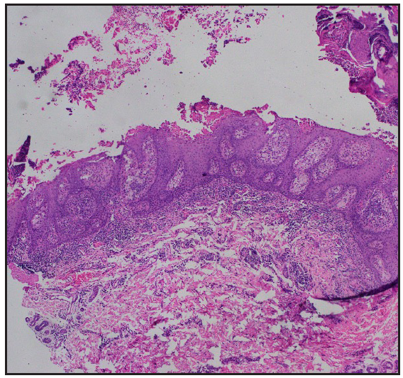 Biopsy from the erythematous friable growth on the left leg showed neutrophils with fibrin in the stratum corneum, along with hyperkeratosis, parakeratosis, papillomatosis and irregular acanthosis of the epidermis (Haematoxylin and eosin, 40x).