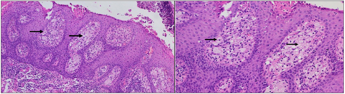 On higher magnification, foamy histiocytes (black arrows) are appreciated in the dermal papillae (Haematoxylin and eosin, 2b- 100x and 2c-200x).