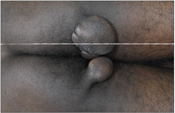 Tuberous xanthomas over the buttocks.