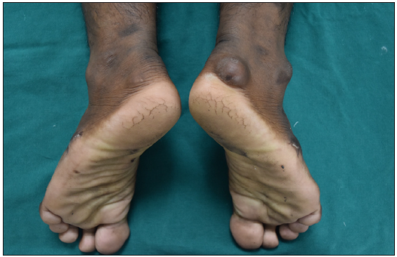 Tendinous xanthoma over the right ankle.
