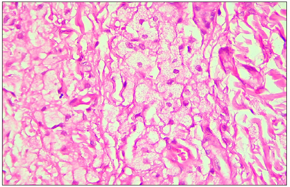 Photomicrograph demonstrated collection of fat-laden histiocytes with bubbly cytoplasm in the dermis. (Haematoxylin and Eosin, 100x)