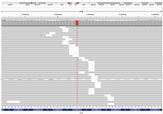 Integrative Genomics Viewer (IGV) screenshot of the mutation in proband (homozygous).