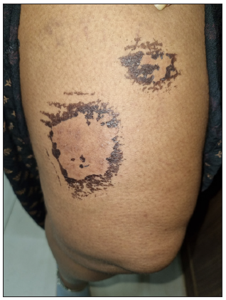 Post-inflammatory hyperpigmentation with mild scaling on the right thigh on the 7th day of contact.