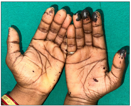 Erythema, blistering, and tenderness on both palms (right > left), seen on the 2nd day of ink spillage.