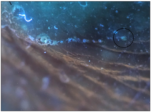 Dermoscopy (Dermlite DL5, UV mode) showing the body of the mite (black circle) more clearly under UV dermoscopy – the ‘ball sign’.