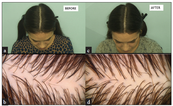 Comparative analysis of the patient’s scalp condition before treatment (a, b) and after treatment (c, d). Images (a) and (c) represent macroscopic views, while images (b) and (d) show trichoscopic findings. Post-treatment images demonstrate increased hair density indicating improvement compared to baseline.