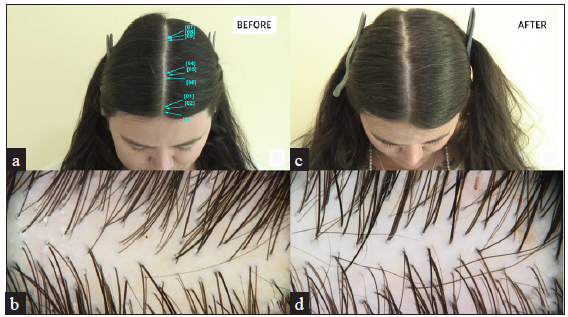 Comparative analysis of the patient’s scalp condition before treatment (a, b) and after treatment (c, d). Images (a) and (c) represent macroscopic views, while images (b) and (d) show trichoscopic findings. Post-treatment images demonstrate increased hair density indicating improvement compared to baseline.