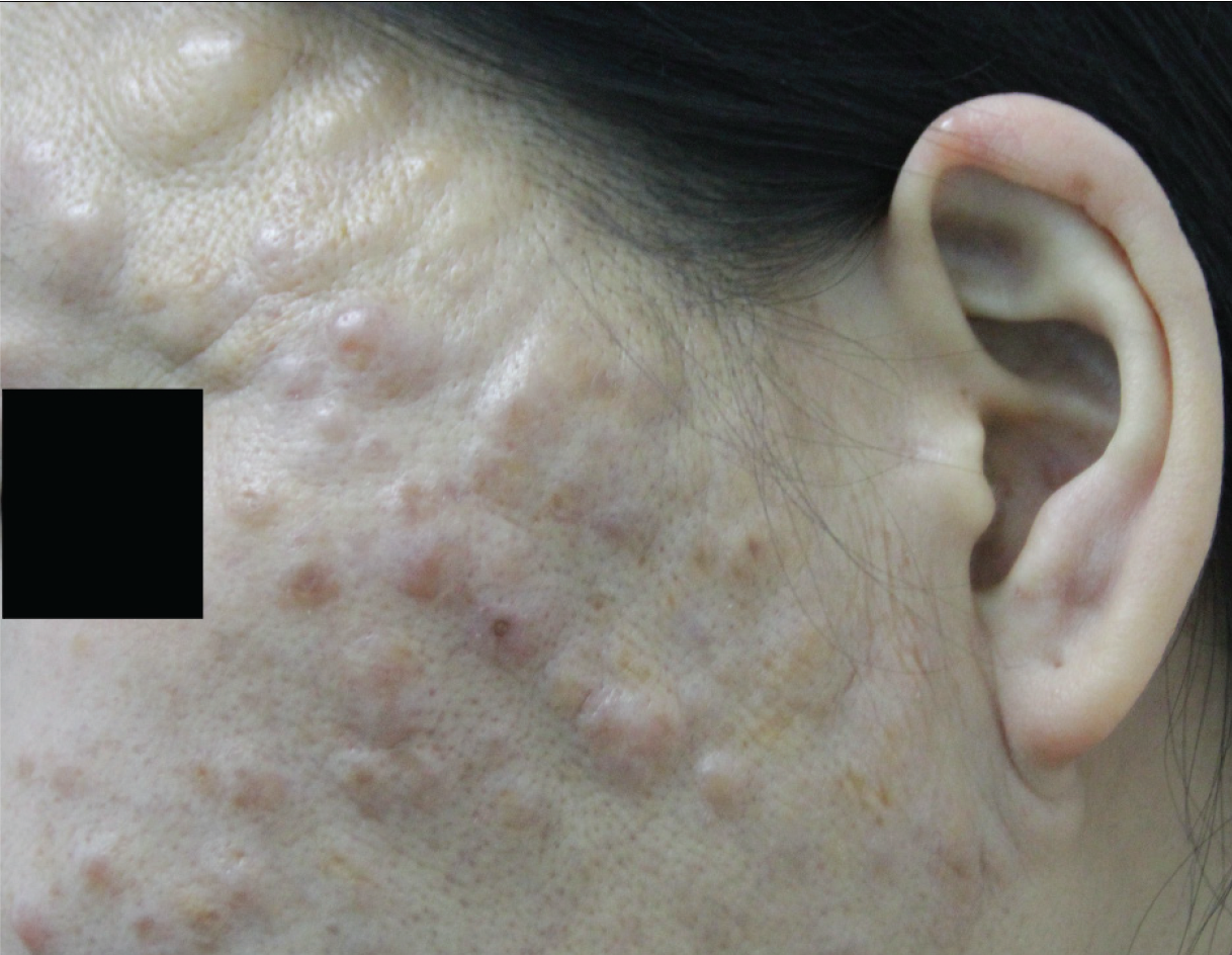 Pustules and nodulocystic lesions limited to the face.