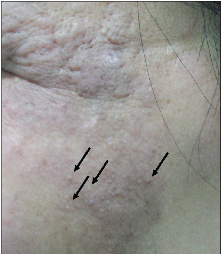 Erythematous plaques with follicular hyperkeratosis (“comedones”) on the left face (arrows).
