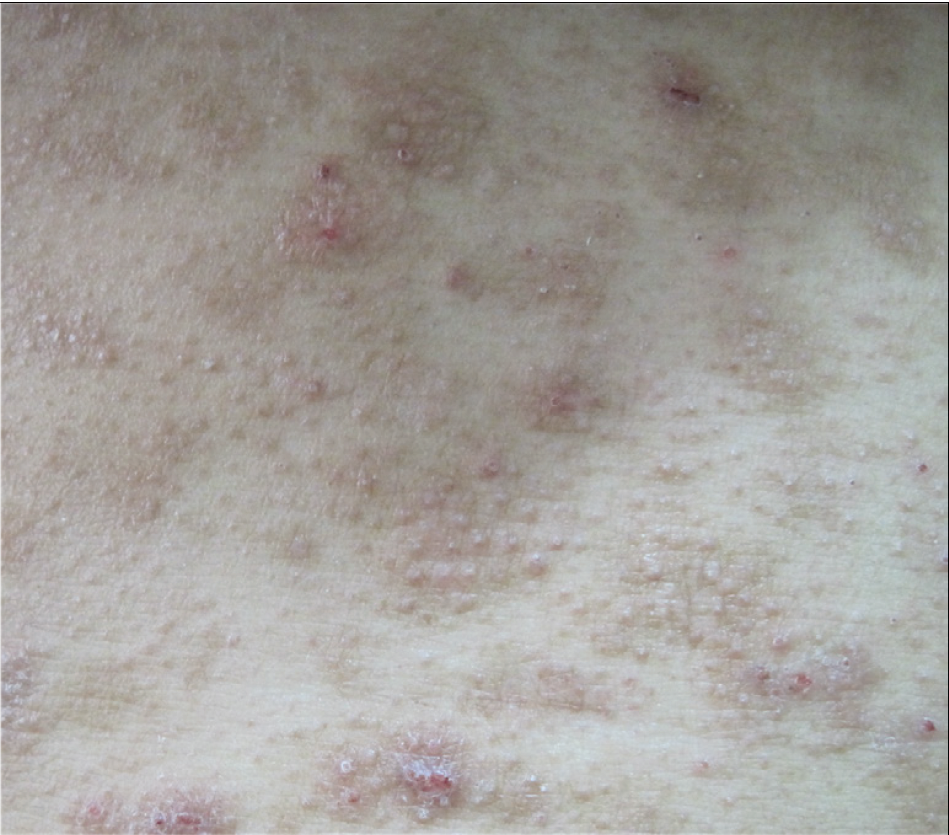 Follicular papules on chest.