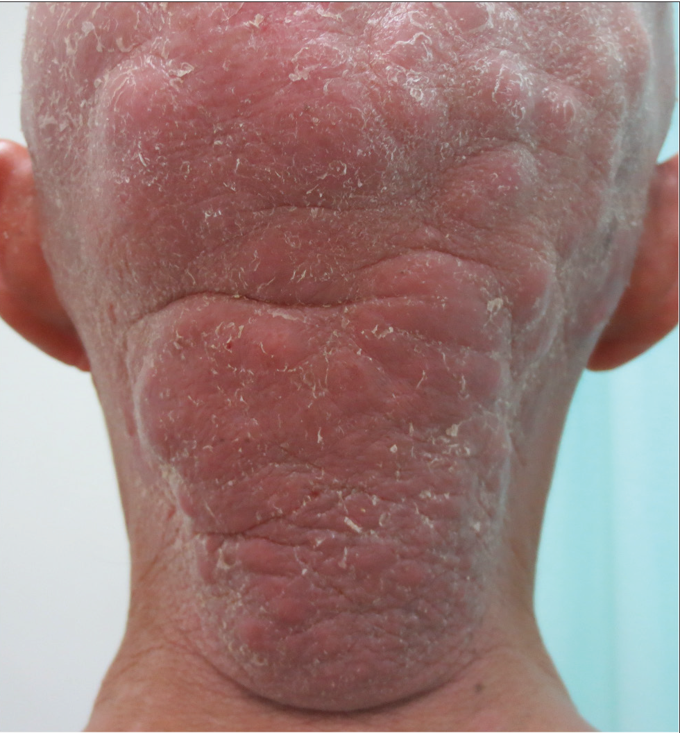 A huge tumour on the head and neck.