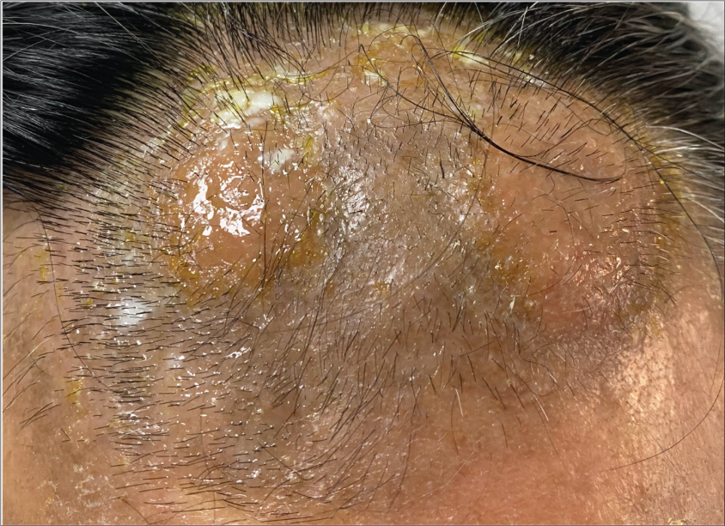 An infiltrated plaque on the forehead before treatment.