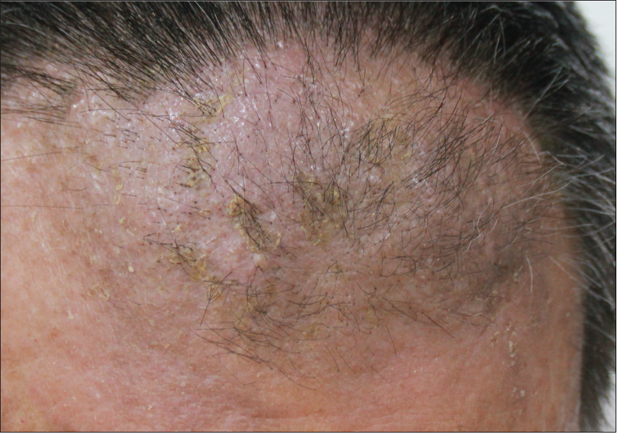 An infiltrated plaque on the forehead after treatment.