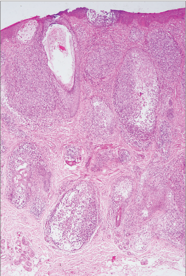 Dense intrafollicular and perifollicular infiltrates and extensive follicular mucinosis (haematoxylin-eosin, original magnification ×40).