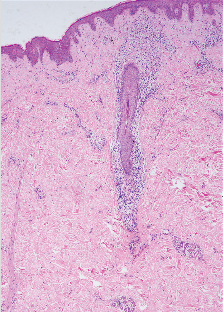 Sparse perifollicular infiltrates (haematoxylin-eosin, original magnification ×40).