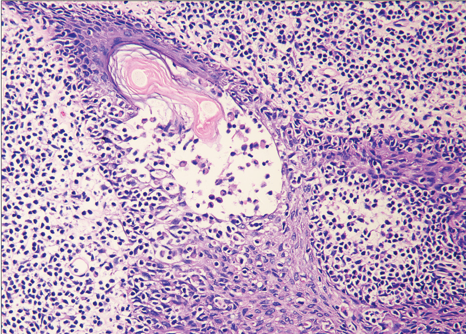 Infiltration of follicular epithelium by small sized atypical lymphocytes with mucin deposition.