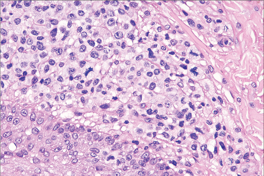 The blast cells made up more than 25% of the infiltrate (haematoxylin-eosin, original magnification ×200).