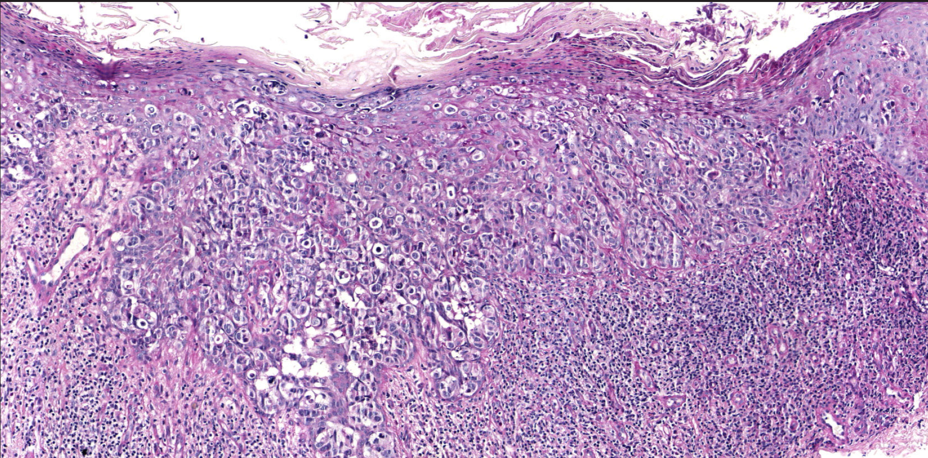 Permeation of the epidermis by tumour cells with vesicular nuclei, visible nucleoli and large vacuolated cytoplasm. In the superficial dermis there was an intense inflammatory infiltrate (haematoxylin and eosin stain, x100).
