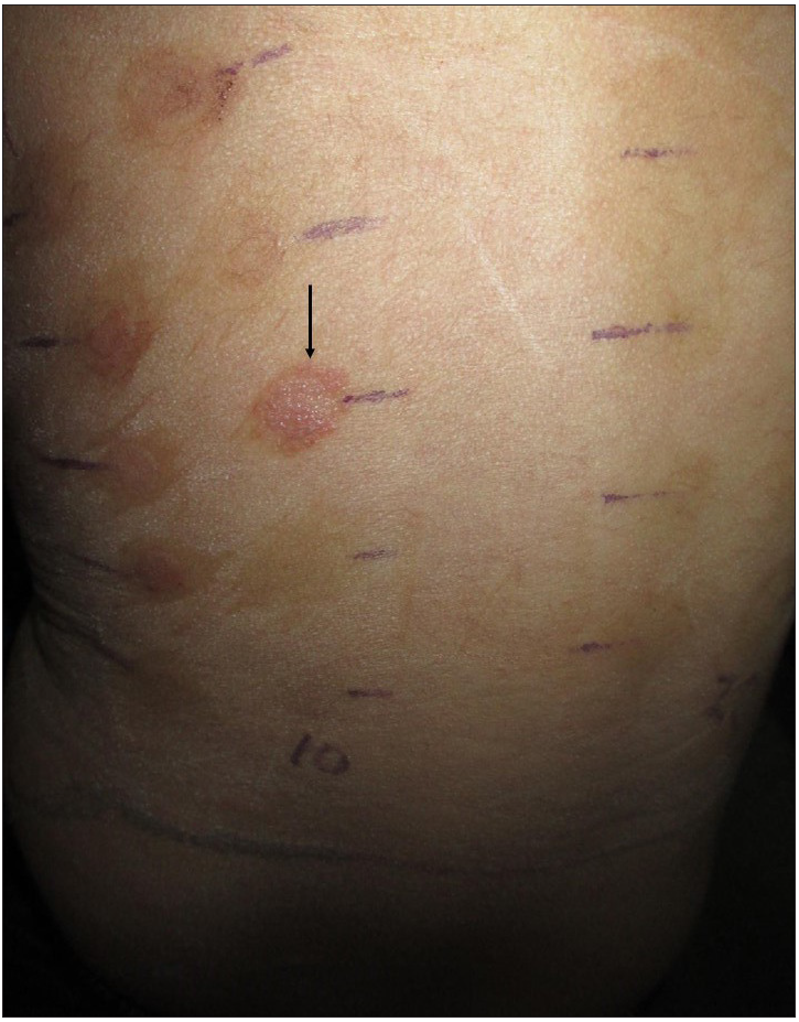 Patch test positivity (2+) to cobalt sulphate at 96 h.