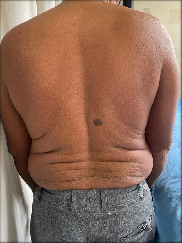 Papular eruption over the back with furrowing of creases visible on lower back (Shar-Pei sign).