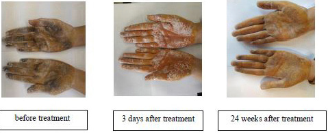 The density and extent of dark areas before treatment, 3 days and 24 weeks after treatment in both hands of a patient in tap water iontophoresis group.