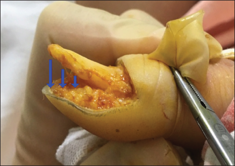 Detachment of bone and soft tissue. Due to hyponychium invasion of melanoma in situ, phalangeal bone and inferior soft tissue are necessarily detached for the achievement of adequate safety margin. For skin graft, stable adherence of bone and soft tissue is needed.