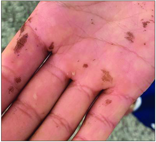 Brownish pigmented macules over the palm.