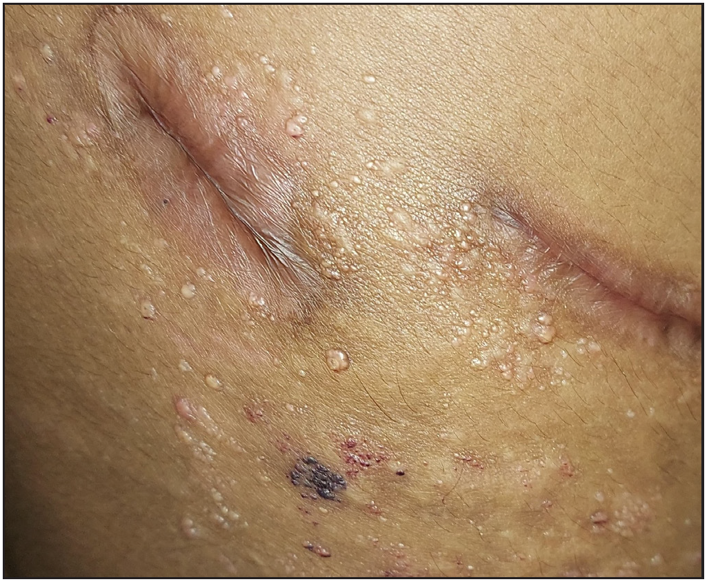 A 20-year-old man with lymphangioma circumscriptum showing multiple clear fluid-filled vesicles with “red-hypopyon”.