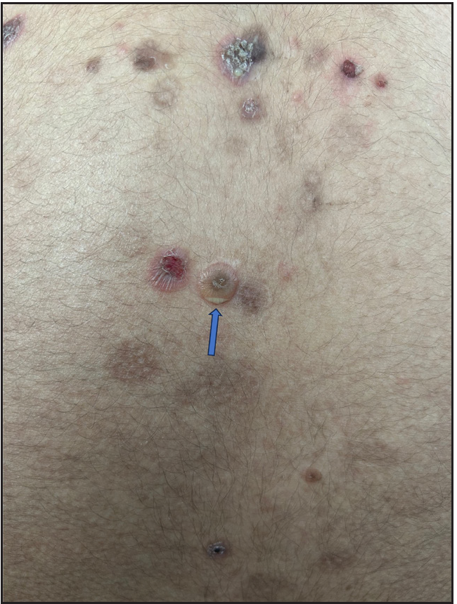 A young woman with pemphigus foliaceous showing small superficial vesicles with “hypopyon” (blue arrow).