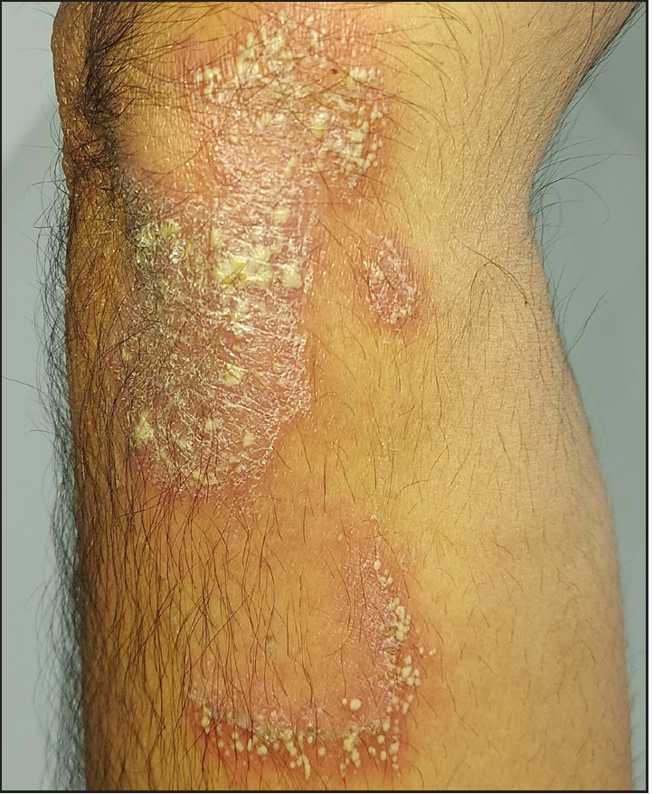 A 25-year-old man with pustular psoriasis showing a well-defined erythematous plaque with overlying pustules.