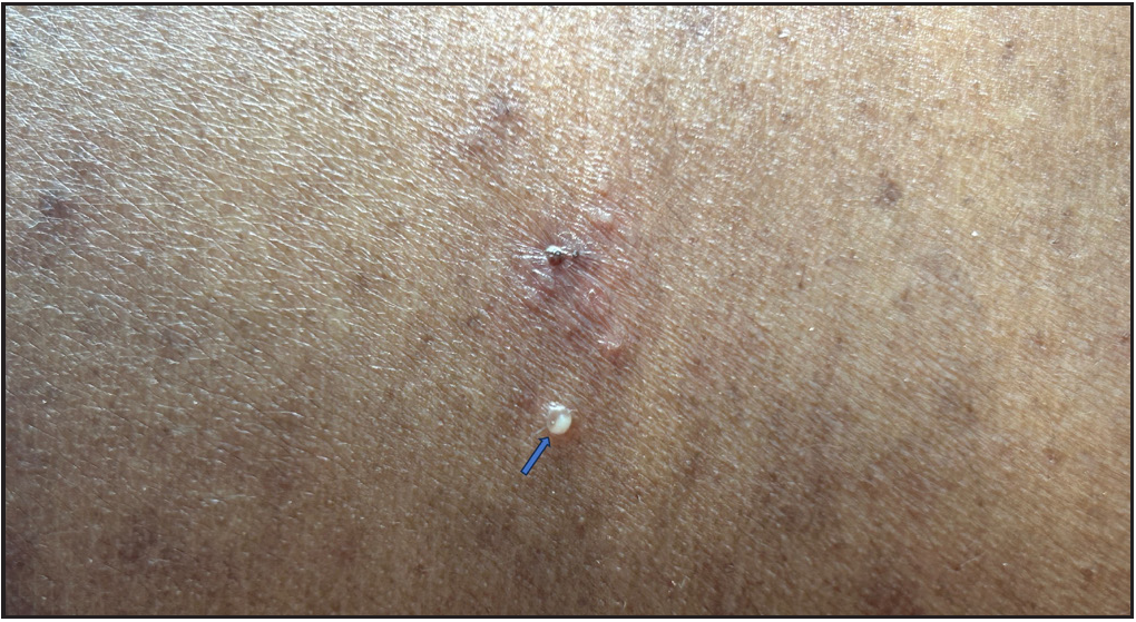 A 4-year-old boy with cutaneous candidiasis showing a tiny vesicle with “hypopyon” (blue arrow).