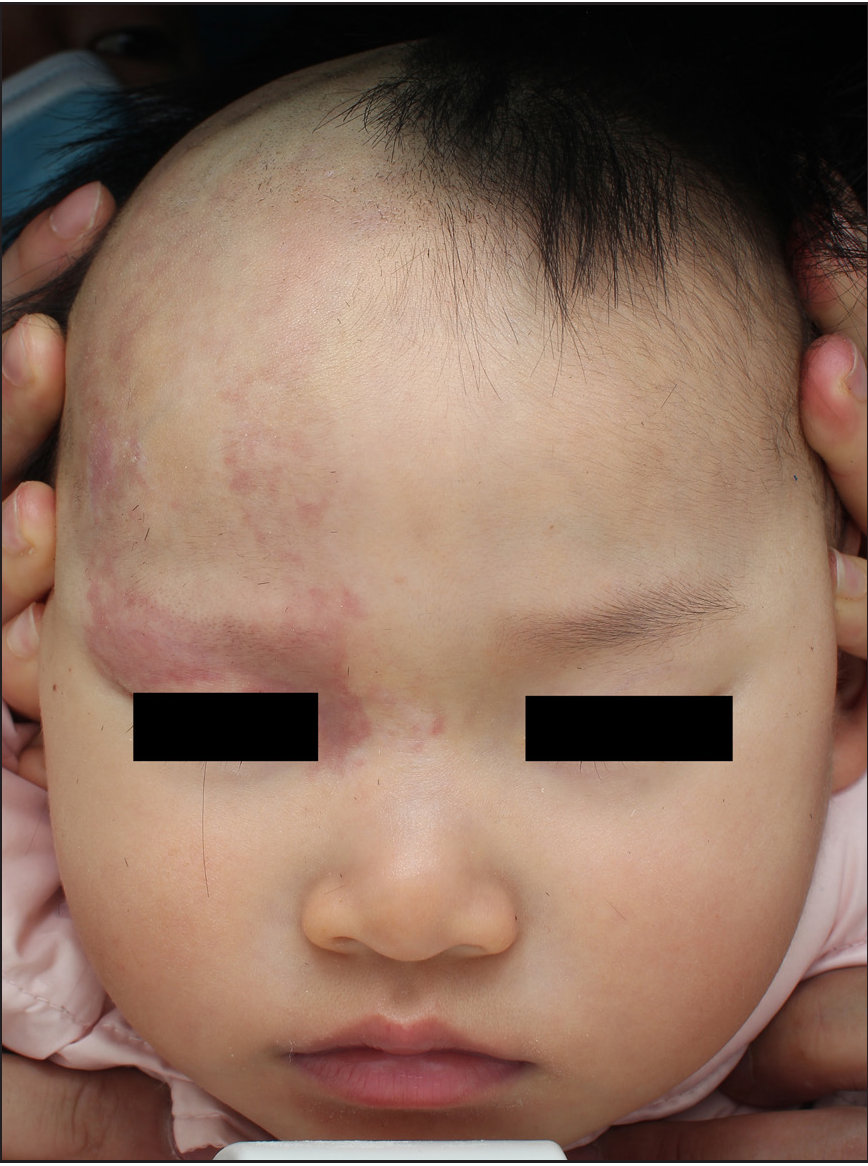 Photodynamic therapy for patients with Sturge–Weber syndrome (SWS): A 2-year-old girl: After two treatment sessions (51–75% improvement)