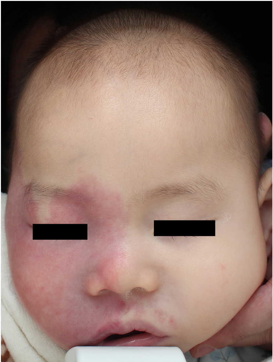 Photodynamic therapy for patients with Sturge–Weber syndrome (SWS): A 1-year-old boy: Before treatment