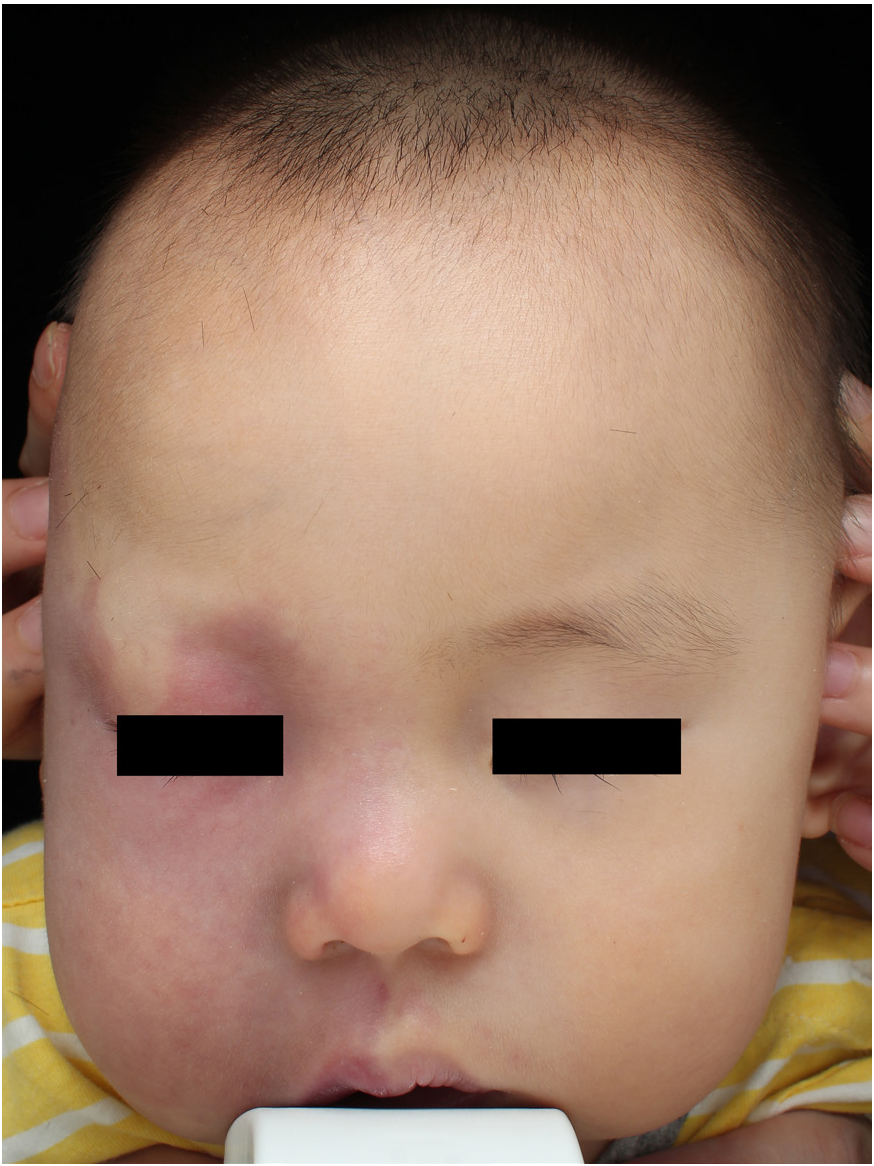 Photodynamic therapy for patients with Sturge–Weber syndrome (SWS): A 1-year-old boy: After two treatment sessions (25–50% improvement).