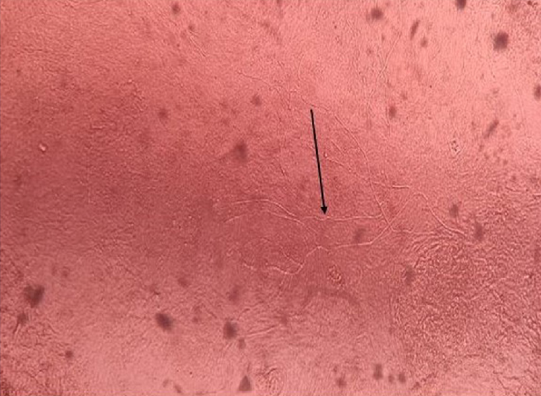 KOH mount from aspirate showing branched hyphae [10x] (black arrow)