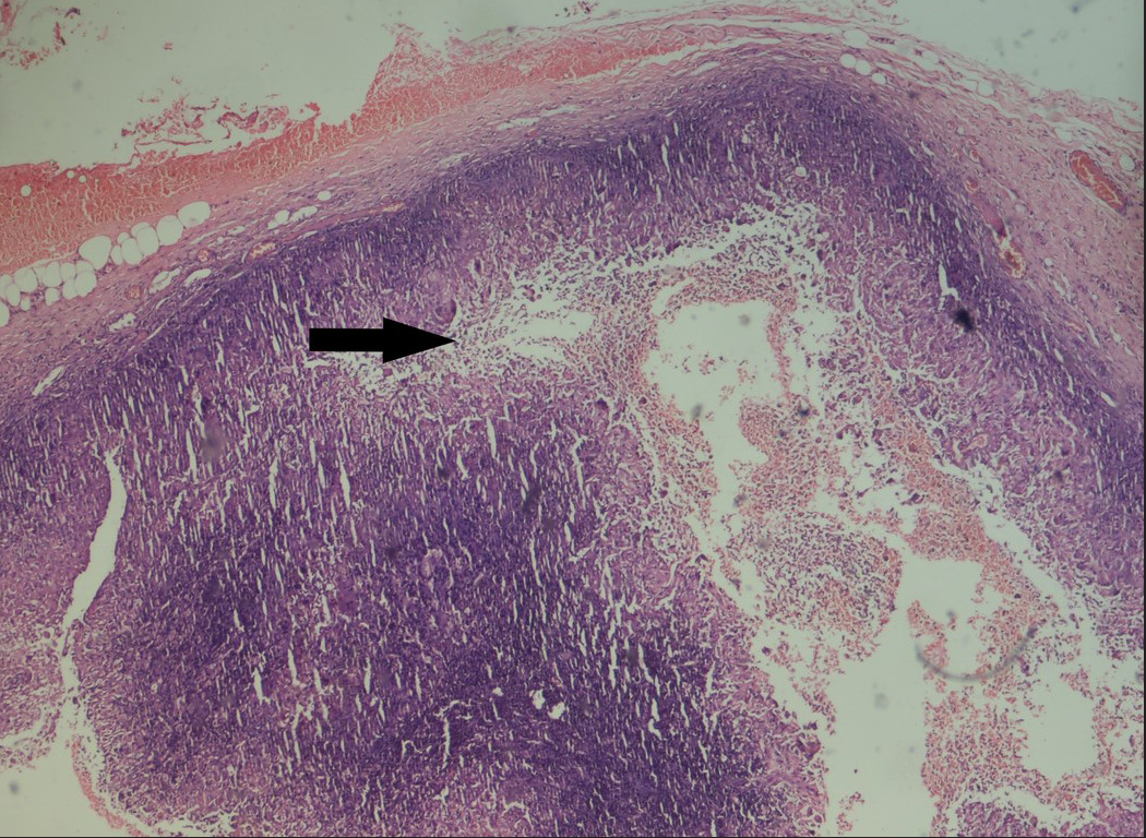 Cystic lesion in the dermis with cyst wall, granulomatous inflammation and necrotic debris at the centre [H&E, 10x] (black arrows)