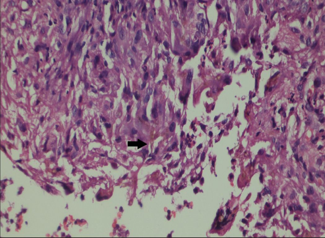 Granulomatous inflammation and necrotic debris at the centre with few pigmented fungal hyphae [H&E, 40x] (black arrows)