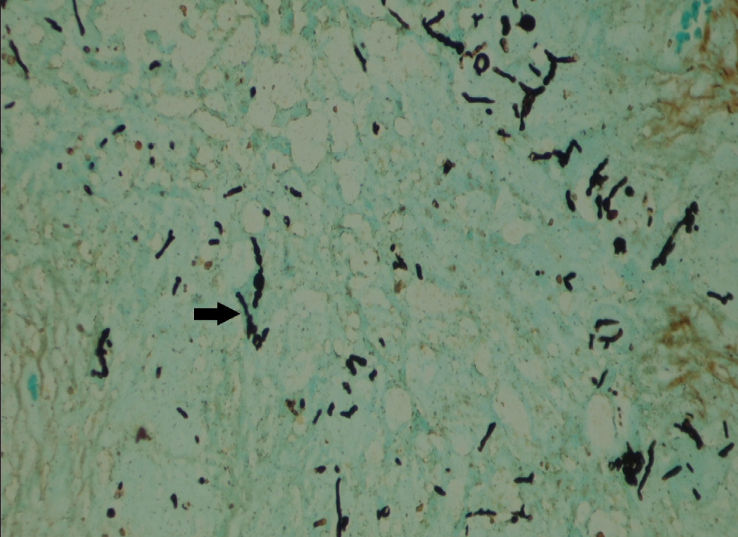 Gomori methenamine silver stain showing silver-stained fungal hyphae [40x] (black arrows)