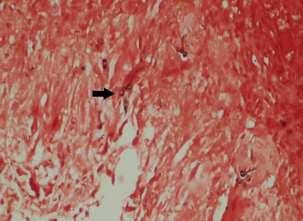 Masson-Fontana stain highlighting the melanin pigments of phaeohyphomycosis [40x] (black arrows)