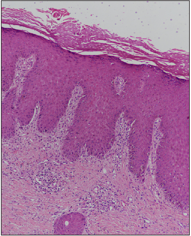 Epidermis shows compact orthokeratosis with focal parakeratosis, prominent granular layer and irregular acanthosis. The papillary dermis shows moderate lymphoplasmacytic infiltrate and vertically oriented collagen bundles (H&E, 100x)