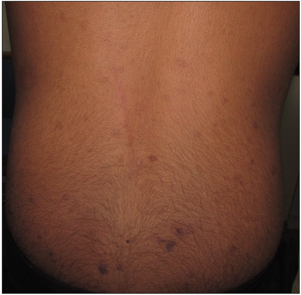 Improvement in the lesions after 3 months of treatment with tofacitinib (post-treatment PGSS -2, mild)