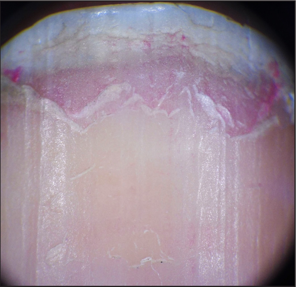 Onychoscopic image of onychoschizia; note pink colored remnants of nail polish. (Dermlite DL3 dermatoscope, polarised mode, 10x)