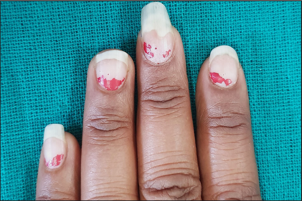 Onycholysis after manicure and probing under nails